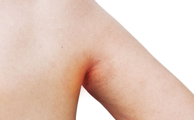 Natural Home Remedies for Chafing
