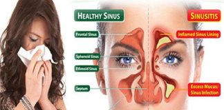 Treated For Sinusitis Without Surgery