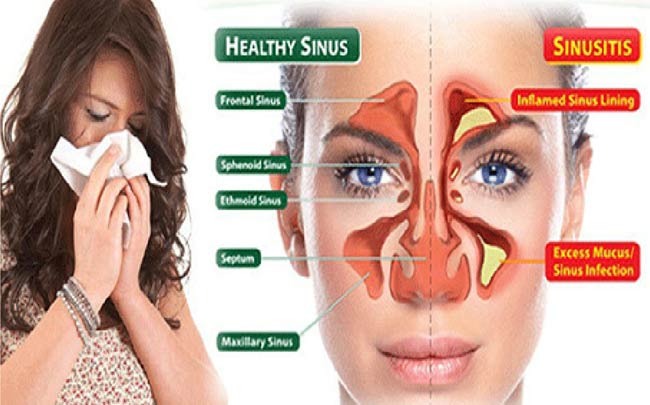 Treated For Sinusitis Without Surgery